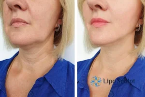 Double chin before and after Hi-Fu treatment 4 Book your double chin treatment Daventry today! We are here to help!