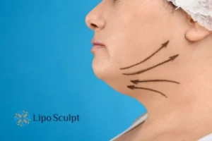 Double chin before and after Hi-Fu treatment 3 Boost your confidence with a Double chin treatment Daventry