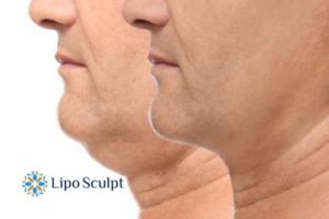 Double chin before and after Hi-Fu treatment 2 Double chin treatment Daventry from Lipo Sculpt - feel more confident today!