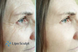 How to Fight Aging Symptoms 2 Do you want to Fight Aging Symptoms Daventry? Contact Lipo Sculpt today!