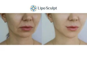 Explaining Total Skin Tightening Treatment And What It Can Do For You 2 Do you want to boost your self confidence? Give Morpheus8 Daventry a try today!