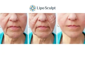 Explaining Total Skin Tightening Treatment And What It Can Do For You 3 Boost your confidence with Morpheus8 Daventry call our team today!
