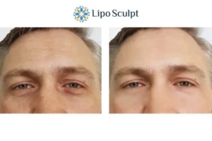 Explaining Total Skin Tightening Treatment And What It Can Do For You 6 Morpheus8 Daventry book in today to find out more!