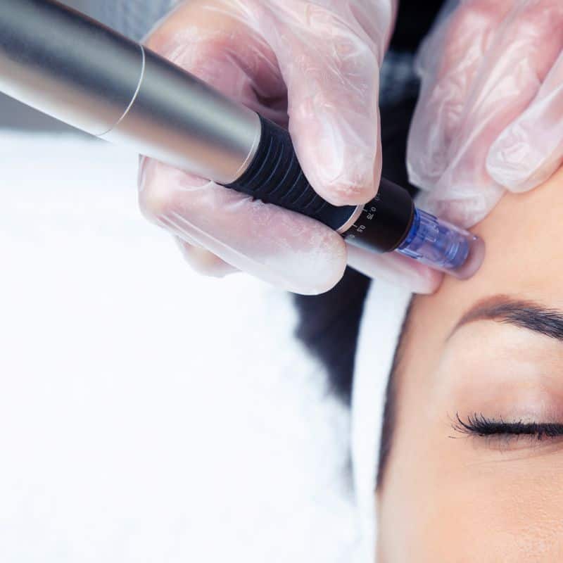 Morpheus8 treatment Daventry from Lipo Sculpt - Book in today!