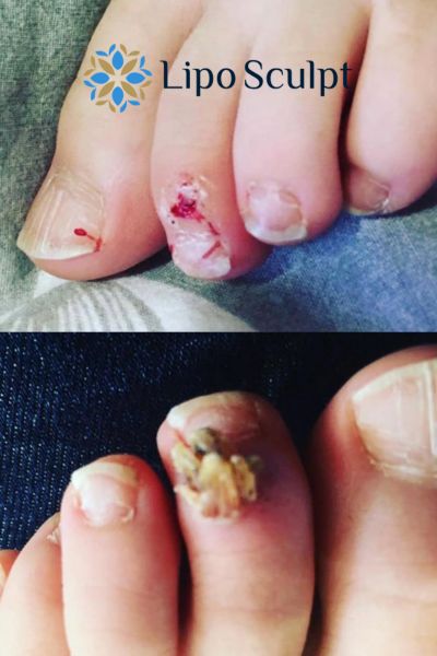 Wart removal customer results from Lipo Sculpt Daventry
