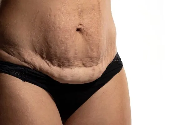 Lost the Weight but Not the Loose Skin? 1 image of womans stomach after weight loss showing loose skin Daventry